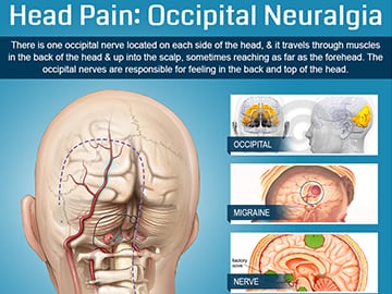 Head-Pain-Occipital-Neuralgia-by-Orange-County-Pain-Clinics-Thumb