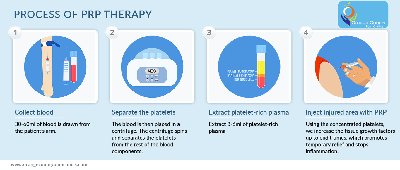 Process-of-PRP-Therapy