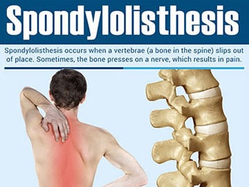 Spondylolisthesis-by-Orange-County-Pain-Clinics-thumb