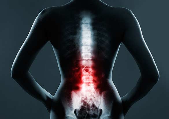 Spinal-Decompression-in-Mission-Viejo-Orange-County-Pain-Clinics